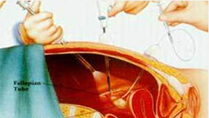腹腔鏡手術