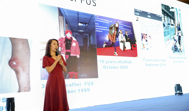 9歲骨腫瘤女孩“無創治療”后已活20年